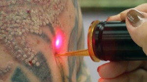 laser tattoo removal does it hrt does it work